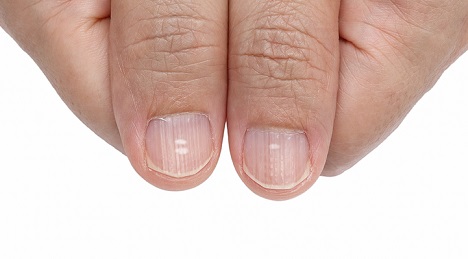 Fingernail Ridges Can Indicate a Thyroid Problem | Piedmont Healthcare