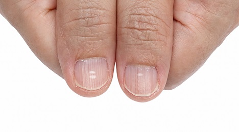 vertical lines on nails