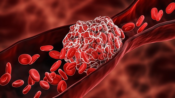 image of a vein with a blood clot