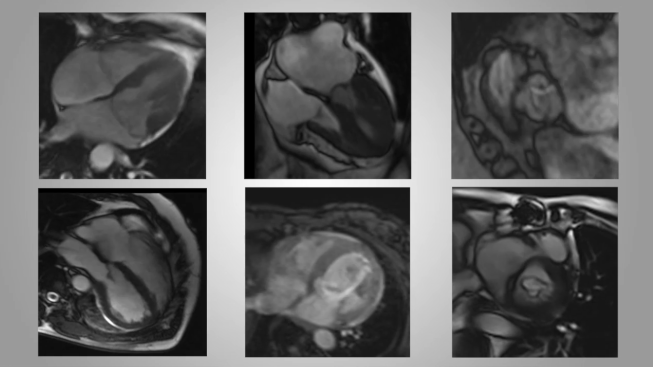Cardiac MRI