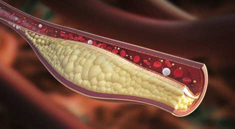 Cholesterol