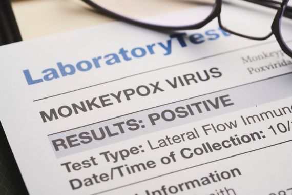 photo of lab results indicating a positive monkeypox virus test