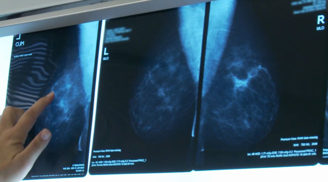 Preventive mastectomy