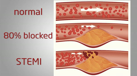 STEMI heart attack