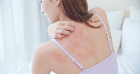 photo of a woman scratching a red rash on her back