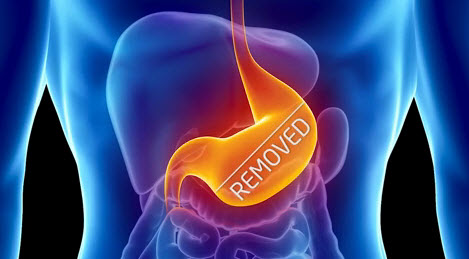 Vertical sleeve gastrectomy