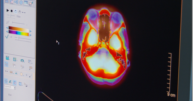 Brain tumor diagnosis