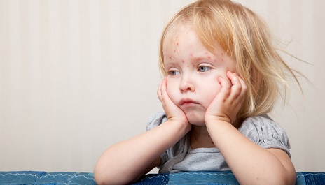 A child with chickenpox.