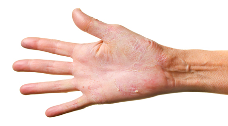 Eczema on a hand. 