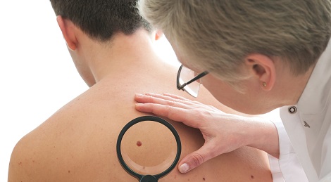 Dermatologist checking a mole.