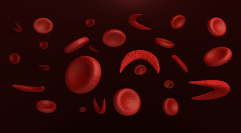 Sickle cell disease is a group of inherited disorders that affect the red blood cells. 