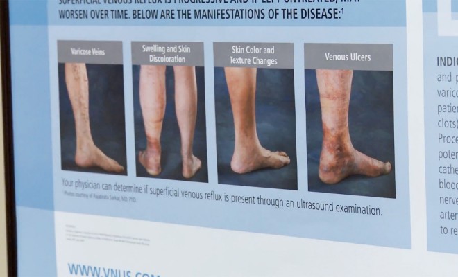 Varicose veins