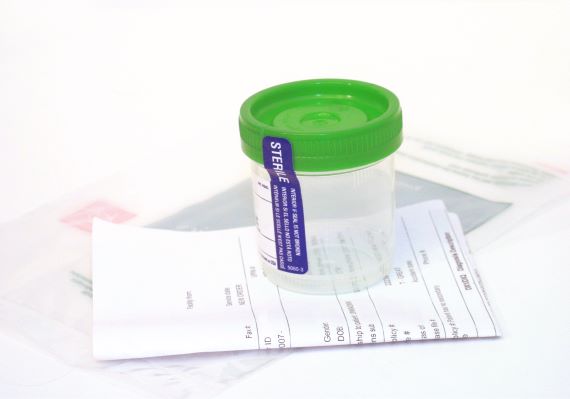 photo of empty urine analysis cup
