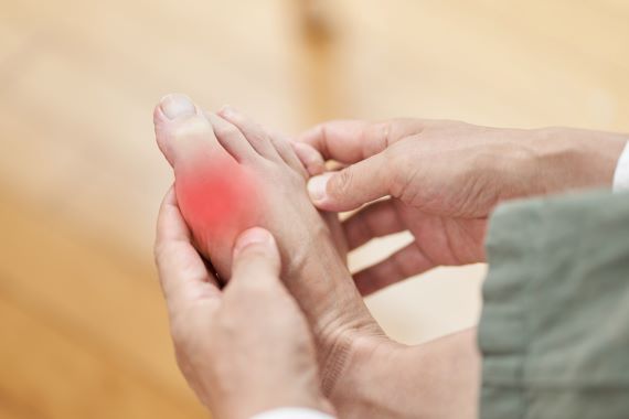 photo of a person's foot with redness at their big toe joint