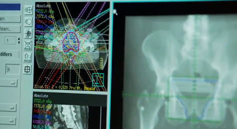 Stereotactic radiosurgery for cancer treatment