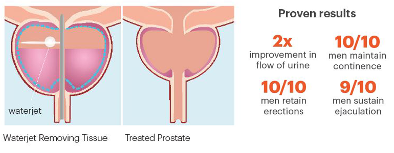 Graphic of treatment for BPH