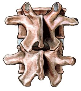 Transforaminal Lumber Interbody Fusion 