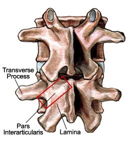 Lumbar Laminotomy and Laminectomy 