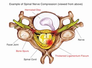 Lumbar Laminotomy and Laminectomy 