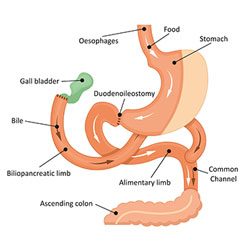 The Biliopancreatic Diversion with Duodenal Switch (BPD/DS)