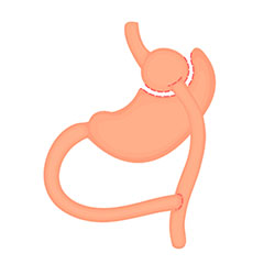 Gastric bypass (Roux-en-Y)