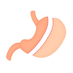 Sleeve Gastrectomy