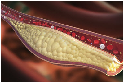 blocked artery