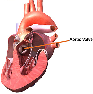 Aortic Valve Disease