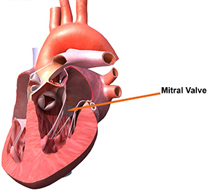 Mitral Valve Disease