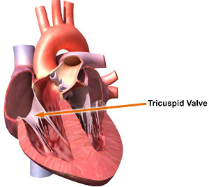 Tricuspid Valve Disease