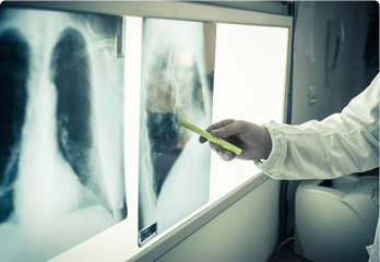 Lung Cancer