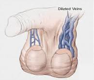 Varicoceles