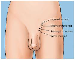 varicoceles